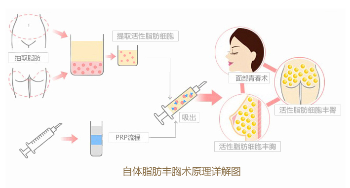 脂肪成活率高有什么好处？