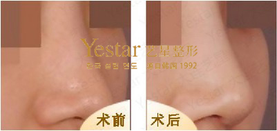 了解您隆鼻以后可以达到的样子