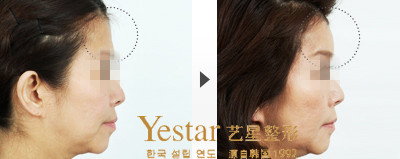 丰额头前后对比图 艺星效果图
