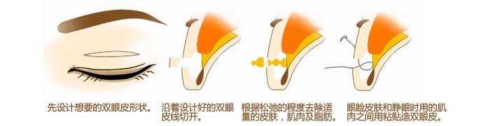 切开重睑法原理图