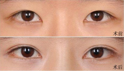 埋线双眼皮前后对比