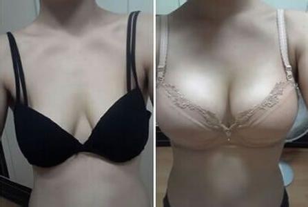 隆胸